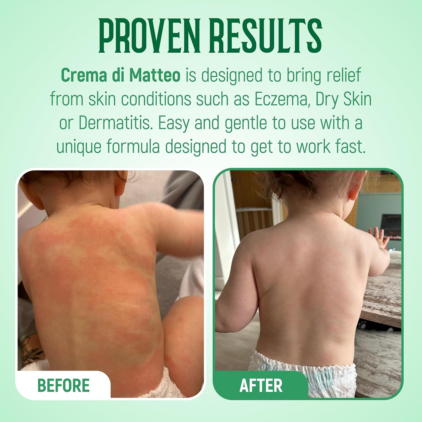 Crema Di Matteo Eczema Cream